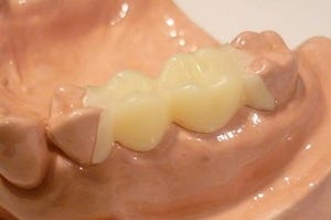 健康な歯と見分けがつかない自然な義歯「ウェルデンツ」誕生