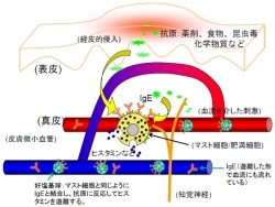 汗に含まれるアトピー性皮膚炎の悪化因子はカビの1種の産生物 