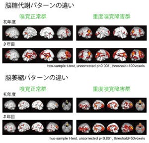 東北大、嗅覚検査でパーキンソン病における認知症発症を予測可能と発表