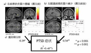 東北大、東日本大震災による健常人のPTSDと脳萎縮の関連を解明
