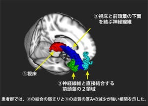 京大、MRIで統合失調症患者の脳の一部の神経回路などの異常を確認