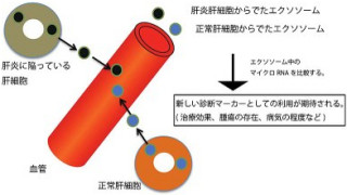 血液中の「マイクロRNA」の測定で慢性肝疾患を診断 - 大阪市立大