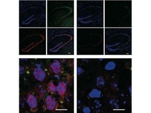 糖尿病がアルツハイマー病を悪化させる - 九大が死後脳から確認