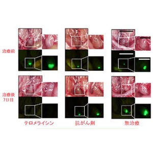 岡山大、体の負担少なく消化器がんのリンパ節転移を完全消去する新治療法