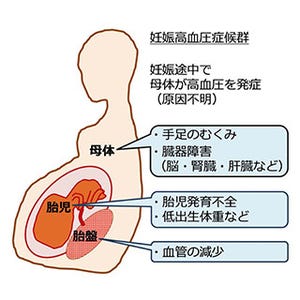 東北大学、酸化ストレスが妊娠高血圧症候群の病態を改善することを発見