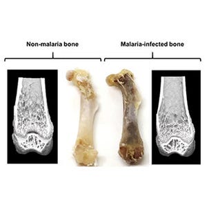 マラリア感染が、完治後も骨量減少の原因となることを発見-大阪大学