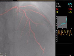フィリップス、心臓冠動脈疾患の血管内治療術を支援する「iFR Roadmap」