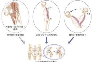姿勢の悪化と脊柱の柔軟性低下が「変形性股関節症」の進行に影響