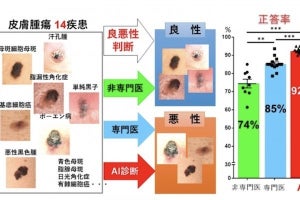京セラなど、皮膚腫瘍の良悪性を高精度で判定するAI診断補助システムを開発