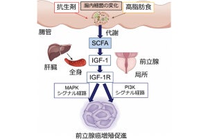 腸内フローラで産生の短鎖脂肪酸が前立腺がんを増殖させる、近大などが確認