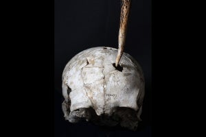 平和な時代とされる縄文人の頭骨に武器によって破壊的に突かれた痕跡、東大が発見