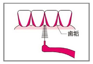 「歯周病予防プログラム」で知る歯間ブラシの効果的な使用法