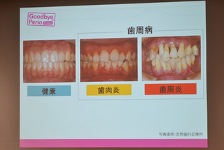 5人に4人は、糖尿病や脳梗塞のリスクを高める歯周病!　どうやって予防する?