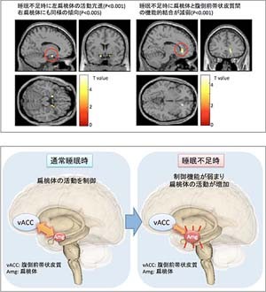 睡眠不足で情動不安定や抑うつに Tech