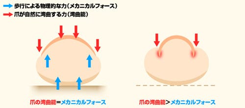 巻き爪を放置するとどうなるの 自分で治す方法を紹介 マイナビニュース