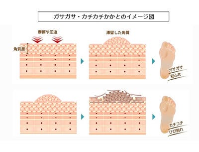 かかとの角質がたまっていると保湿ケアをしても効果がない マイナビニュース