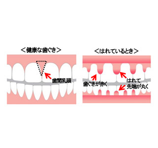 歯周病予防のためにチェックしておくべき3点を歯科医師が解説