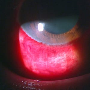 結膜下出血 の対策法は 蒸しタオル が効果的 予防法を眼科医が解説 マイナビニュース