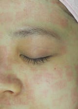 韓国発 オラクル美容皮膚科 で話題のレーザー治療を受けてきた 1 マイナビニュース