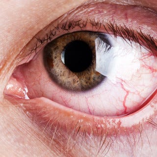 充血 病気 の 目 早く眼科を受診した方がいい充血とは？