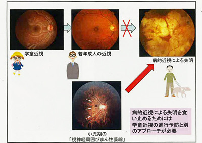 的 近視 病