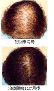 薄毛になりやすい女性の髪型は 専門医に聞く薄毛の種類と原因 1 マイナビニュース