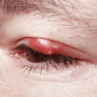 寝起きに突然まぶたが腫れた 目の腫れで疑われる病気とその対処法 マイナビニュース