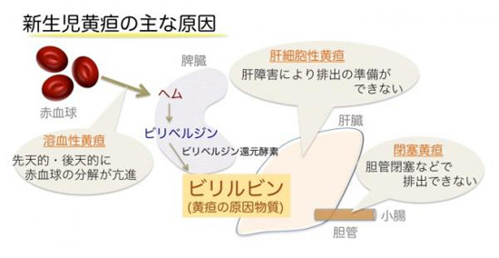 久留米大など 新生児黄疸の原因となる生体内反応の仕組みを解明 Tech