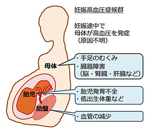 東北大学 酸化ストレスが妊娠高血圧症候群の病態を改善することを発見 Tech