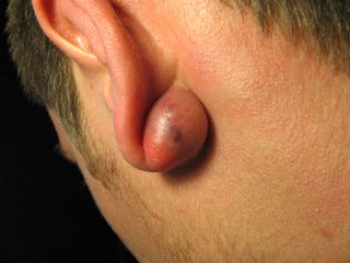 しこり 痛い の 後ろ 耳