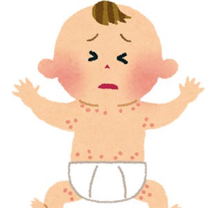 乳児湿疹とアトピー性皮膚炎はどう違う? - 症状が出やすい場所や判断材料