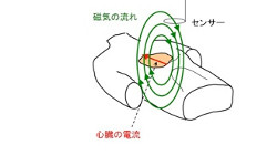 心磁図検査でarvcにおける致死性不整脈発生の予測が可能に 国循 Tech