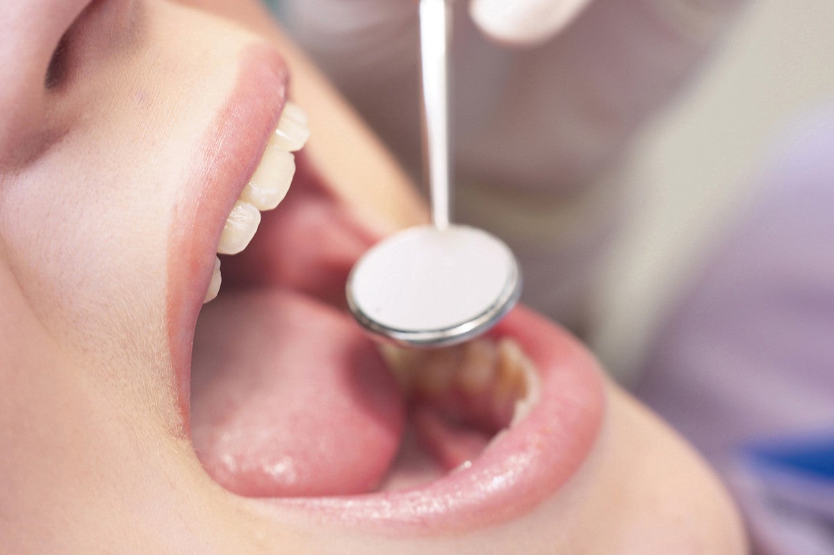 歯の 黒い点 は初期虫歯の可能性 できやすい場所や治療法を解説 マイナビニュース