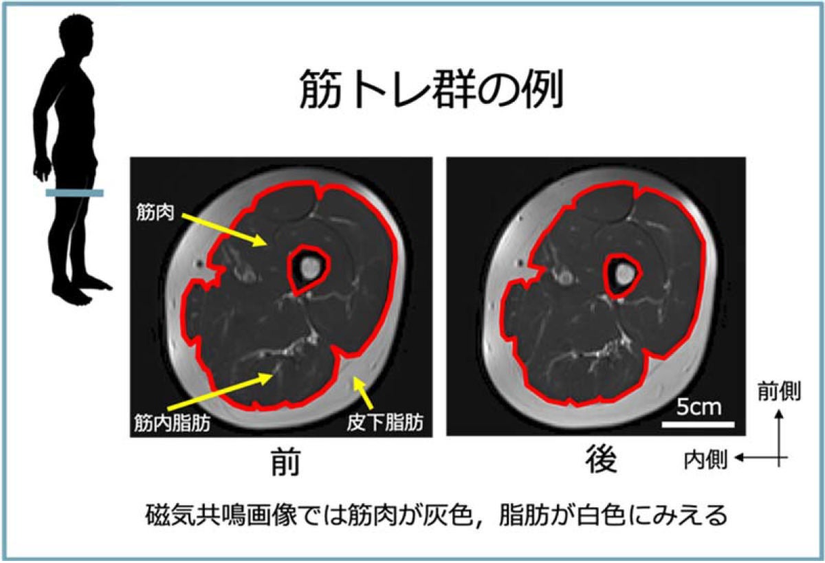 寝たきりでも筋トレを行えば 筋内脂肪 を減らせる 名大が発見 Tech