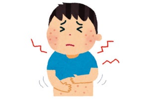 アトピー性皮膚炎のかゆみの原因と治療薬が発見される - ネット「こりゃ大発見」「さよならアトピー」