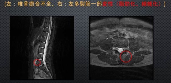 たかが 腰痛 で人生に絶望した話 2 やっぱり骨は折れていなかった Tech