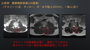 たかが 腰痛 で人生に絶望した話 2 やっぱり骨は折れていなかった Tech