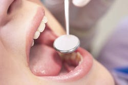 口内炎と口腔がんの違いとは何 定期的なチェック方法を口腔外科医が解説 マイナビニュース