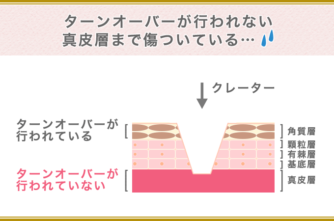 クレーターニキビ跡