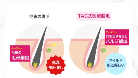 福岡taクリニックの Tac式医療レーザー脱毛 は痛みが少なく安心 脱毛