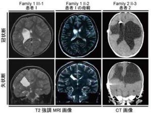 横浜市大、大脳半球内の先天性の異常である「孔脳症」の原因遺伝子を発見