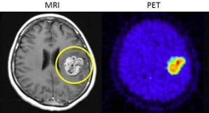 北大、「ポジトロン断層撮影法」による脳腫瘍の性質を診断する手法を開発