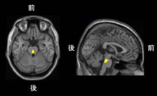 漱石の「坊ちゃん」はセロトニントランスポーター密度が低い人 - 放医研