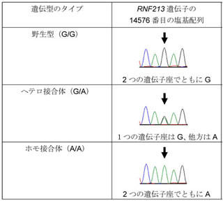 横浜市立大学など、重症型もやもや病の遺伝マーカーを発見