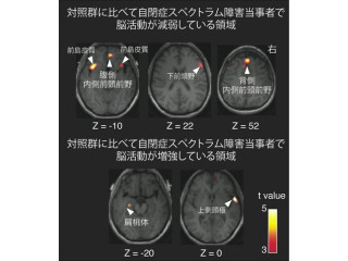 東大、「自閉症スペクトラム障害」における脳の特定領域の活動不全を発見