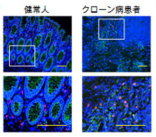 東大、炎症性腸疾患を悪化させる免疫細胞の新たな活性化メカニズムを発見