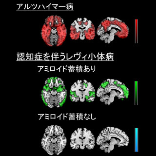 放医研など、アミロイドの蓄積と認知症を伴うレヴィ小体病の関連を確認