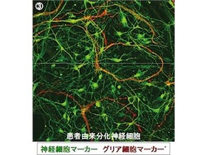 iPS細胞技術でてんかん「ドラベ症候群」の神経細胞を誘導 - 福岡大など