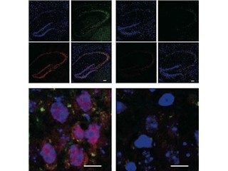 糖尿病がアルツハイマー病を悪化させる - 九大が死後脳から確認