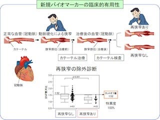 東大病院など、心臓カテーテル検査の実施を簡単に判定できる検査法を